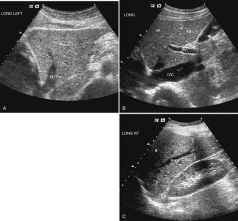 Liver Ultrasound Anatomy