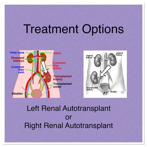 Fundraiser by Marcie Hedges : Help Georgia get a Kidney Auto Transplant