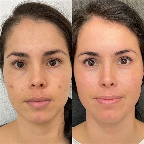 Microneedling Before And After Patient 01 The Refinery Medical Aesthetics