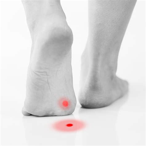 Plantar Wart Stages of Healing: A Comprehensive Guide - MyHealthGeek