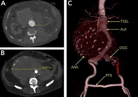 Pre-operative computed tomography angiography of re-ruptured AAA. Type ...