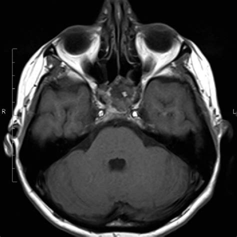 Mr Imaging Of The Head With Contrast T1 Weighted Image Sphenoid Sinus