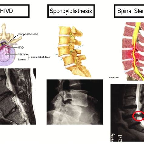 Three types of spinal disease with similar symptoms. An X-ray of each ...