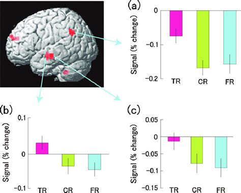 Statistical Parametric Map Of Regions Showing Greater Activation During