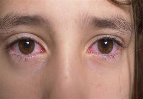 Conjuntivitis Al Rgica En Ni Os Rea Oftalmol Gica Avanzada