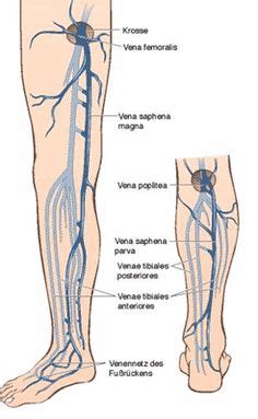 Great Saphenous Vein Thrombosis - http://www.greatsaphenousvein.net/great-saphenous-vein ...