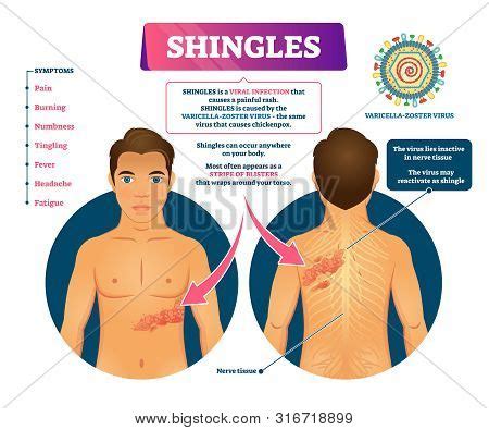 Shingles Vector Vector & Photo (Free Trial) | Bigstock