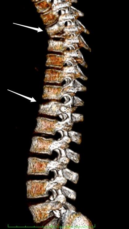 Princess Olivia's Journal: Hopeful: Vertebra Plana and Bone Regrowth, Back Braces