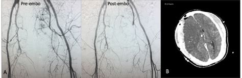 Pre And Post Embolization Pelvic Angiography A And Head Ct B Of