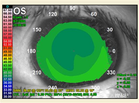 NNN 3 Corneal Topography Examples