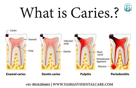 Dental Cavity & Caries Treatment - Treatment, Consequence Cost,