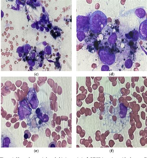 Figure 3 From Secondary Hemophagocytic Syndrome In A Patient With