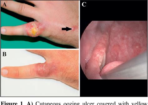 Figure 1 From Mucosal Relapse One Year After Complete Remission Of