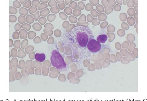 Figure From Hemophagocytic Syndrome Associated With Mycoplasma