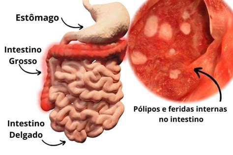 Para que serve o exame de colonoscopia Conheça os detalhes e sua