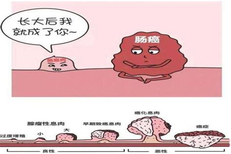 肠息肉的症状有哪些？怎样预防肠息肉 知乎