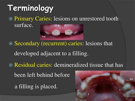 Histopathology Of Dental Caries