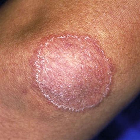 Ringworm Vs Eczema Symptoms Causes Treatments