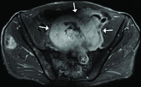 Malignant Peripheral Nerve Sheath Tumor In A Man With Neurofibromatosis