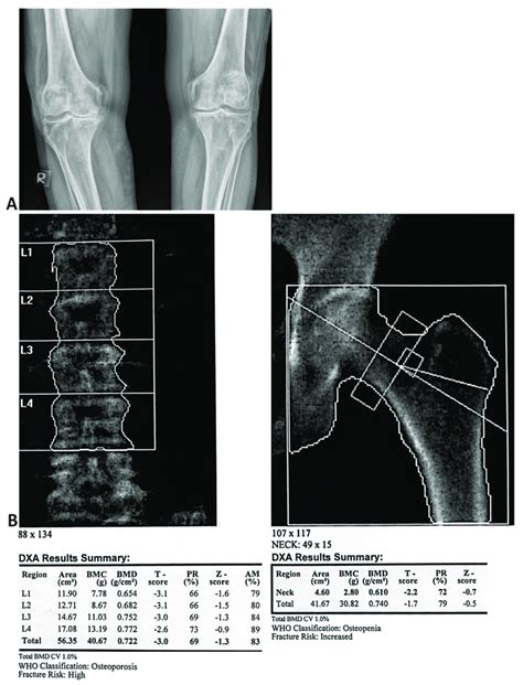 A Posteroanterior Radiographic View Of Bilateral Knees Demonstrating