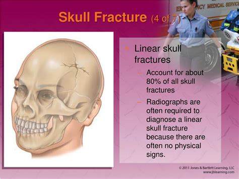 Types of skull fracture - donuv