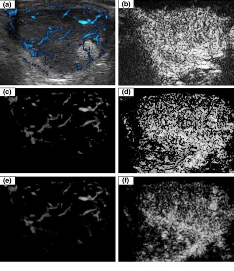 Figure 2 From Quantitative Analysis Of Thyroid Tumors Vascularity A