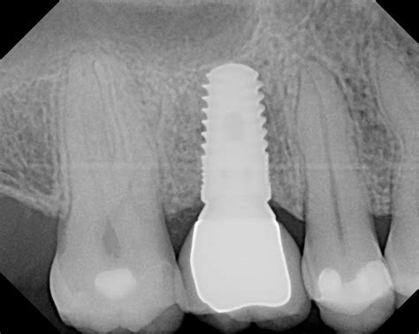 Coating Implants with Bioactive Glass to Promote Implant Fixation ...