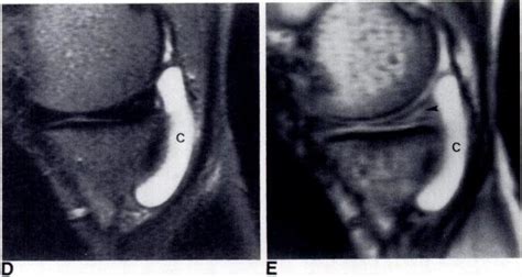 Large Posterior Medial Meniscal Cyst A Coronal Se 200020 Image