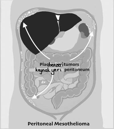 Peritoneal Mezotelyoma Prof Dr Sezaidemirbas