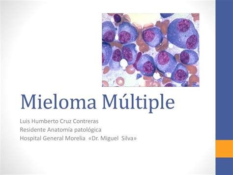 PPT Mieloma Múltiple PowerPoint Presentation free download ID 4839622