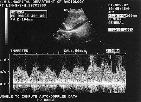 2 D And Doppler Ultrasonography The Next Day After The Second Pta