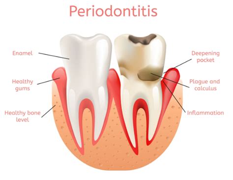 Best Periodontist In Hyderabad Periodontics Alux Dental