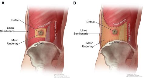 Lateral Abdominal Wall Reconstruction