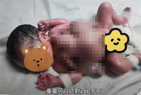 深圳一男婴出生时4手4脚，医生：为全球罕见寄生胎，术后患儿恢复良好 腾讯新闻