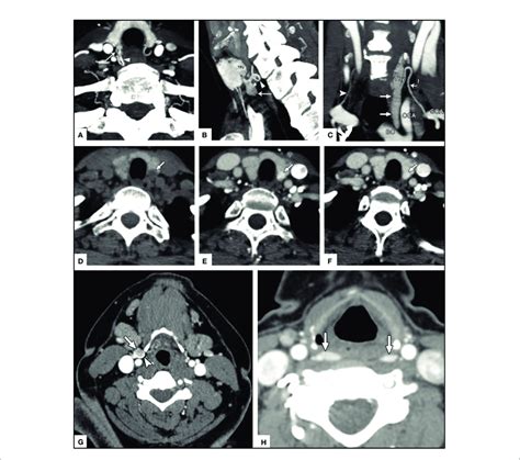 Dct Imaging Of Parathyroid Adenomas Upper Panels A Arrow Head On