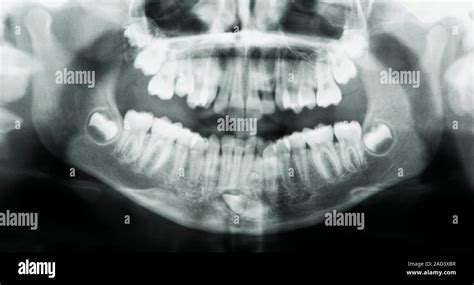 Supernumerary tooth. Panorex (panoramic X-ray) of the jaws and teeth of ...