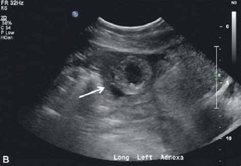 Ectopic Pregnancy Radiology Key