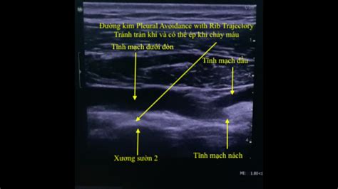 Ultrasound guided Subclavian Vein Identification Xác định tĩnh mạch