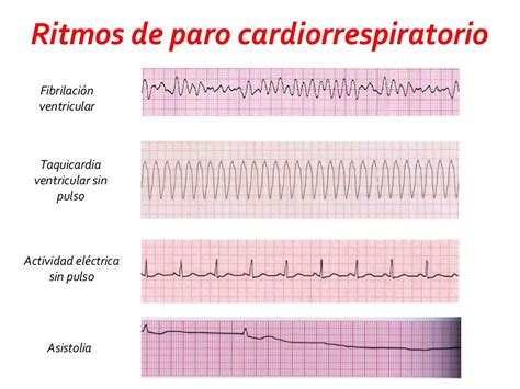 Tipos De Ritmos Cardíacos Braincp