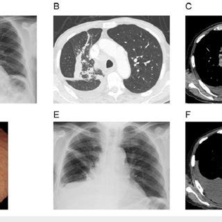 Radiological And Bronchoscopic Findings On The First And Second