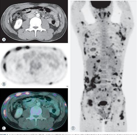 PDF Usefulness Of F 18 FDG PET CT In Subcutaneous Panniculitis Like T