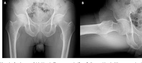 Figure 1 From Occult Fracture Of The Femoral Neck Associated With