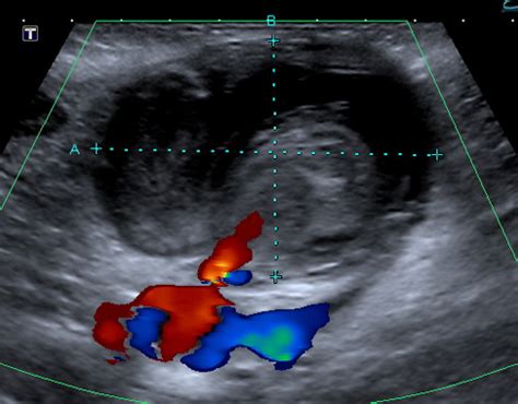 Pseudoaneurysm | Cedars-Sinai