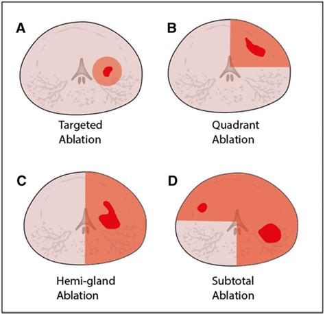 Axial Schematic Views Of Prostate Gland With Cancer Foci In Red And