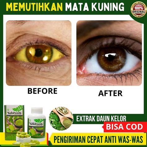 Jual Cara Memutihkan Mata Kuning Secara Alami Obat Mata Kuning Di