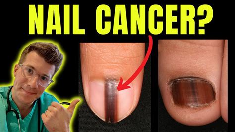 Cancer Of The Nail Doctor Odonovan Explains Acral Lentiginous