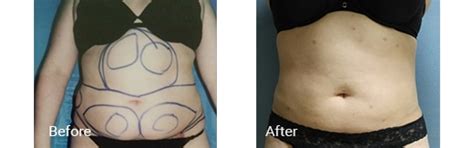 Best Tumescent Liposuction in Miramar & Hollywood, FL