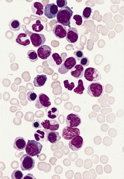 Pathology Outlines Chronic Myelomonocytic Leukemia Cmml