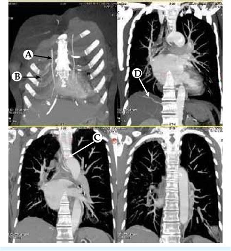 Figure 2 From Unilateral Pulmonary Artery Agenesis In An Elderly Female