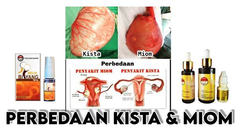 Perbedaan Kista Dan Miom Dan Bagaimana Cara Kerja Propolis Dan Biyang